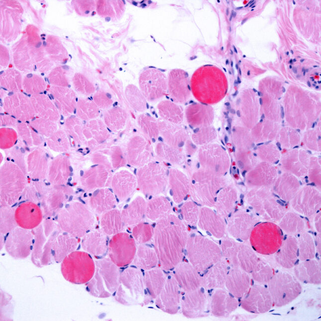 Duchenne muscular dystrophy micrograph -- biotech coverage from STAT