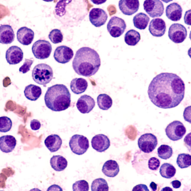 CAR-T cilta-cel for multiple myeloma