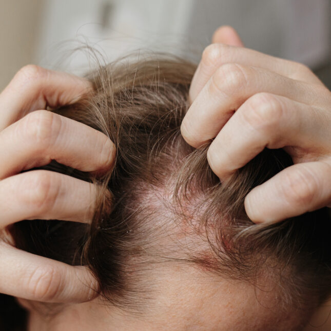 A person scratch psoriasis on their head skin with both hands — coverage from STAT